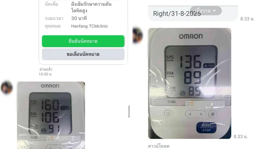 นัดฝังเข็มรักษาความดันโลหิตสูงและค่าความดัน 160/106 เป็น 136/89